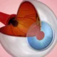 Seeing Clearly: Exploring the Factors Contributing to Glaucoma